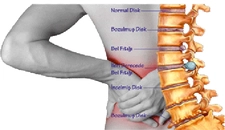 Bel Fıtığı ve Kireçlenme Belirtileri ve Tedavisi Bel Fıtığı ve Kireçlenme Belirtileri ve Tedavisi