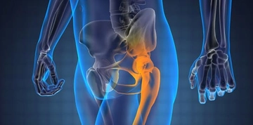 Kalça Kireçlenmesi Belirtileri ve Tedavisi Kalça Kireçlenmesi Belirtileri ve Tedavisi